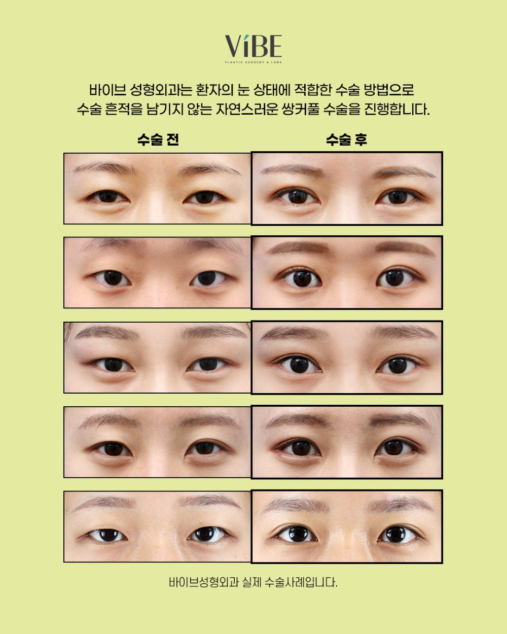 2026 수능 이벤트_카드뉴스3_눈성형-2.jpg